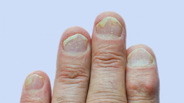 Psoriasis Kuku